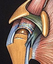 Schéma rupture rétractée (tendon supra épineux)