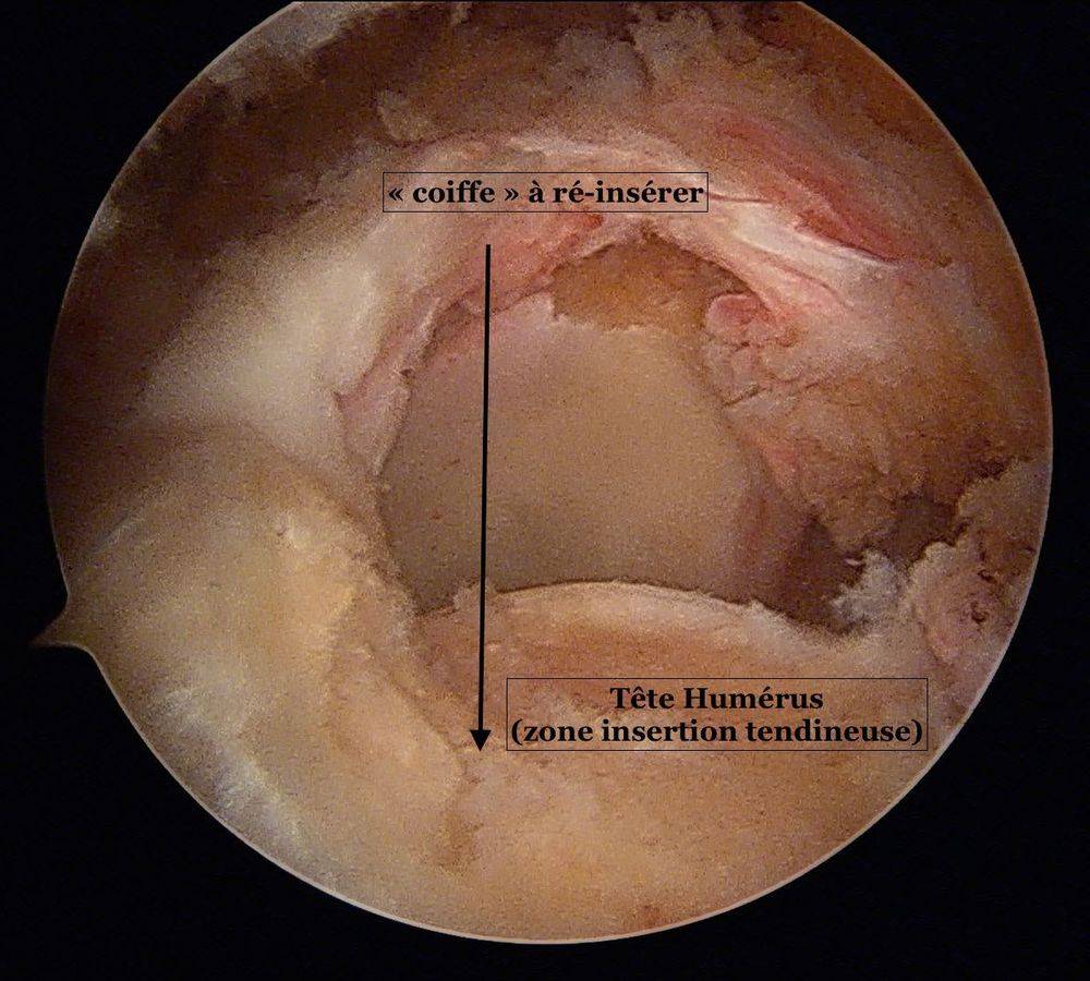 Rupture rétractée du supra-épineux - Dr Milin, Grenoble