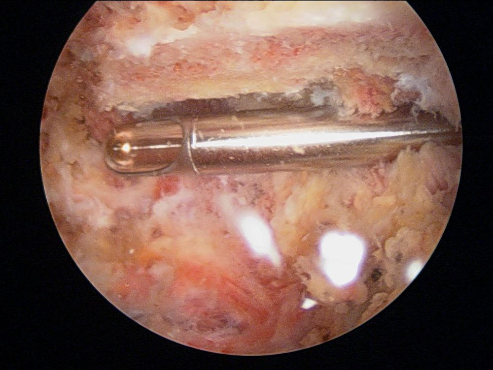 Bec acromial réséqué