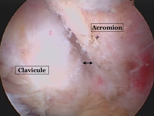 Face inférieure d'une articulation acromio-claviculaire arthrosique