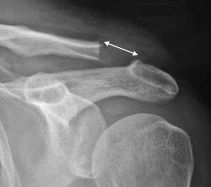 Radiographie après résection acromio-claviculaire