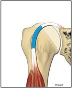 Schéma simplifié du tendon du long biceps