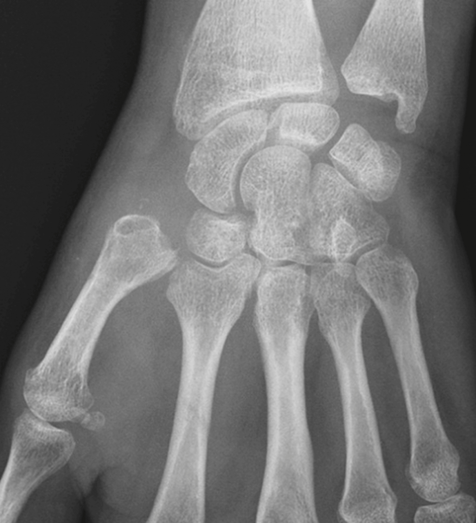 Arthrose du pouce Rhizarthrose Centre épaulemain du Dauphiné
